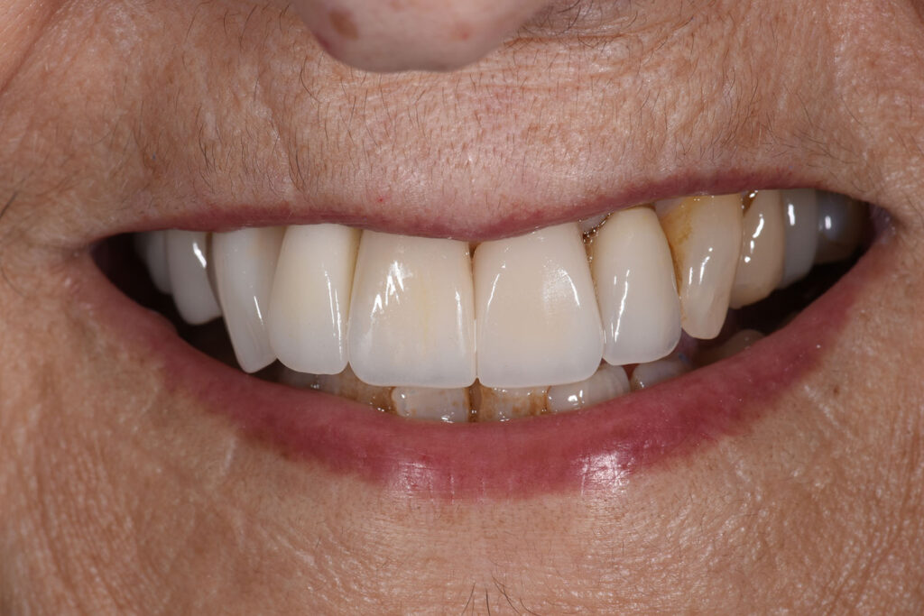 After treatment — smile transformation case 1
