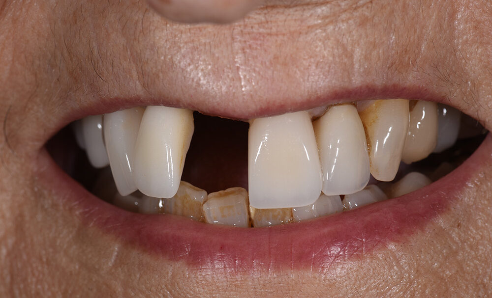 Before treatment — smile transformation case 1