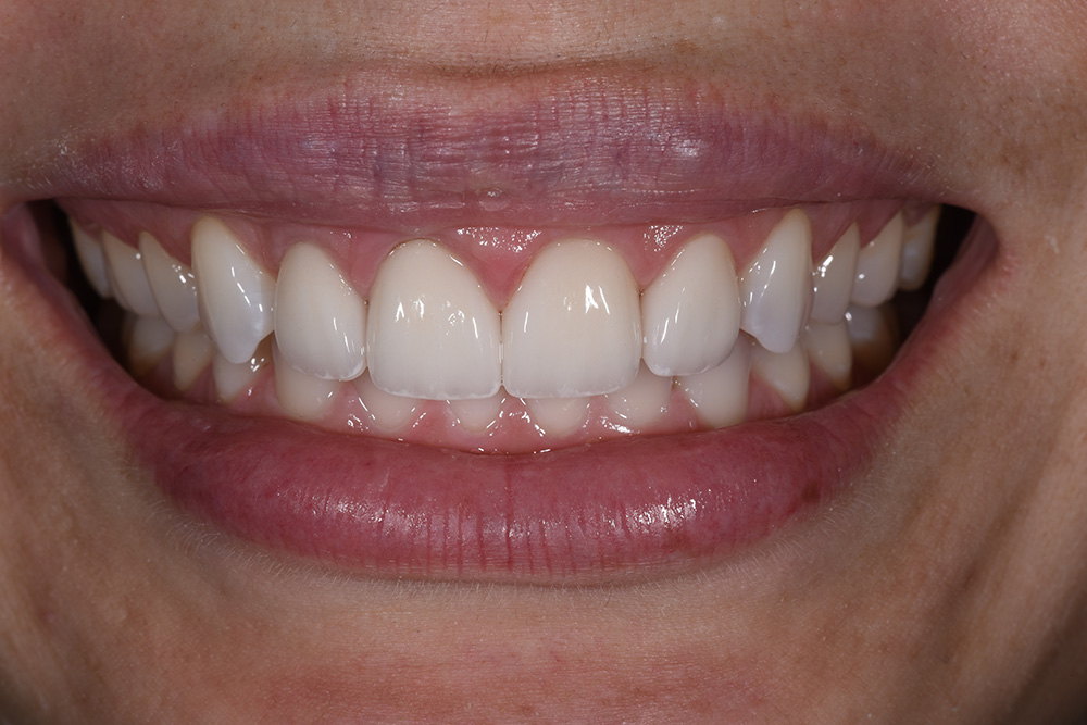 After treatment — smile transformation case 2