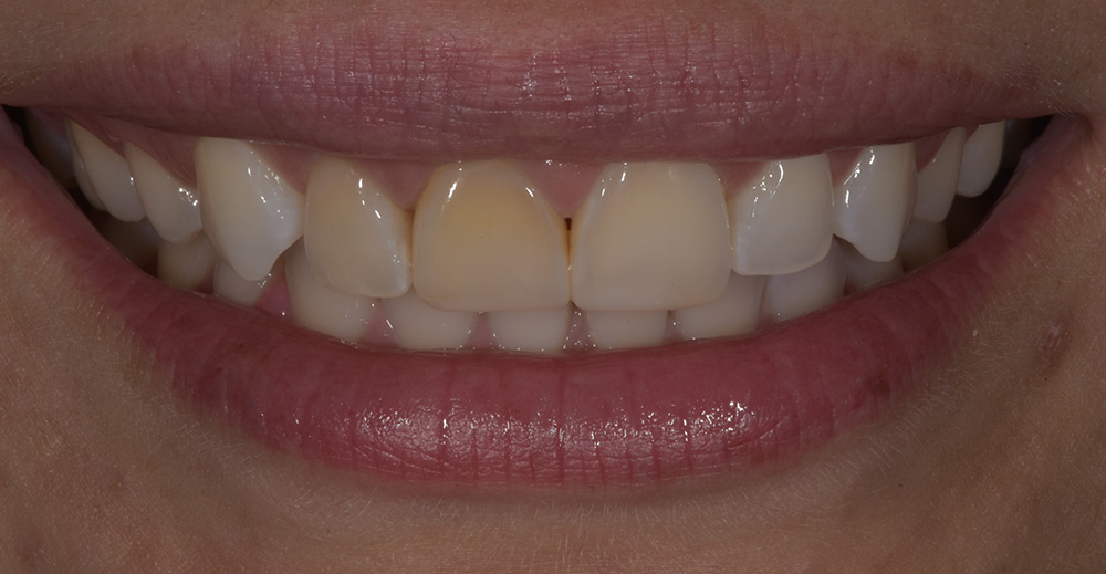 Before treatment — smile transformation case 2