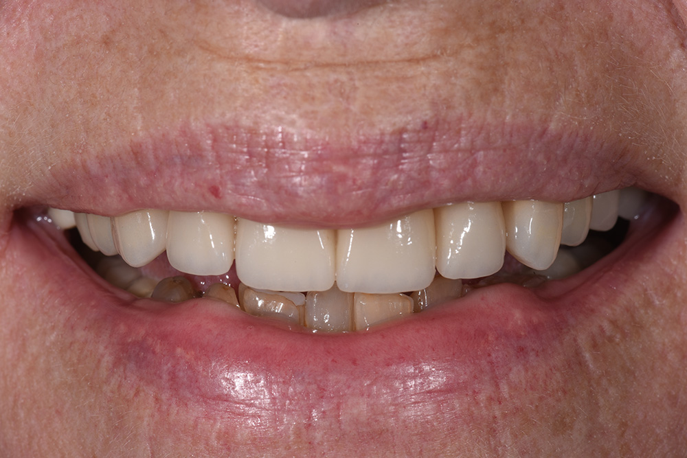 After treatment — smile transformation case 3