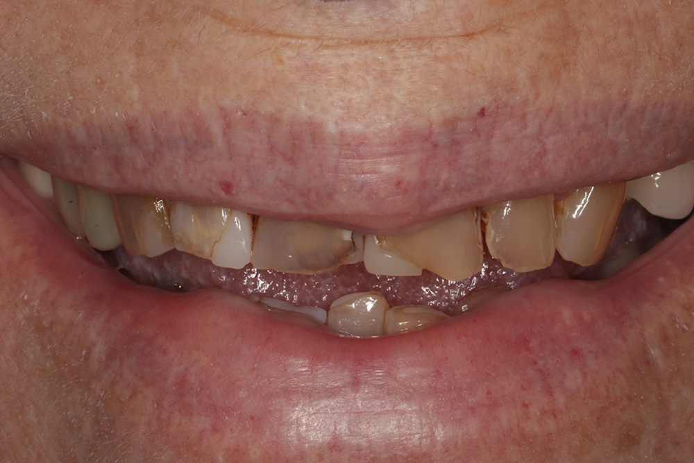 Before treatment — smile transformation case 3