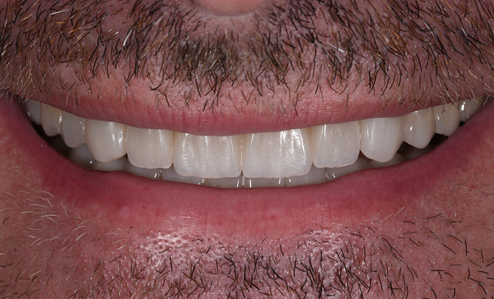 After treatment — smile transformation case 4
