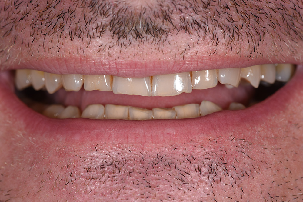 Before treatment — smile transformation case 4