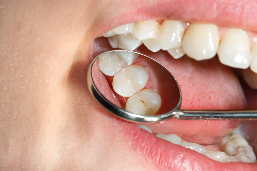 How to Not Get Cavities: Simple Steps